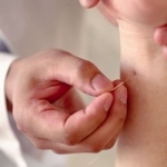 Acupuncture Guide - Everything You Need To Know About Acupuncture Treatment!