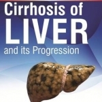 Prevention Measures for Cirrhosis of Liver and its Progression